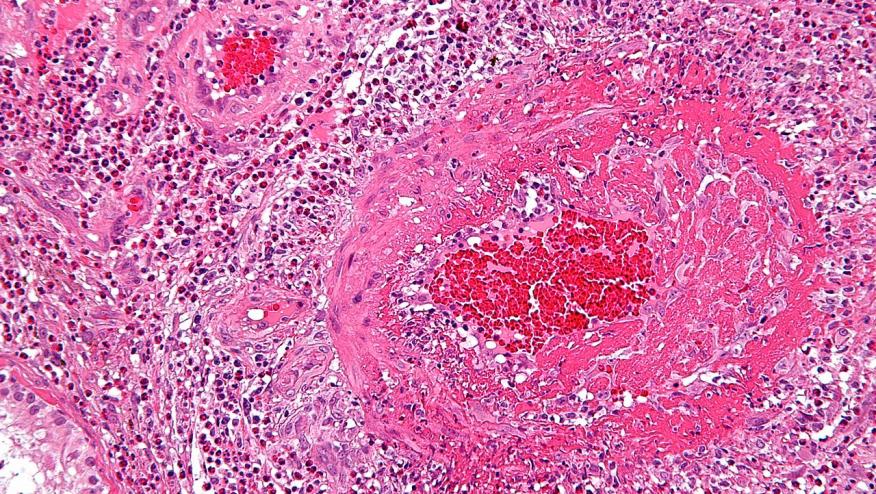 Mepolizumab Dosing In Eosinophilic Granulomatosis With Polyangiitis